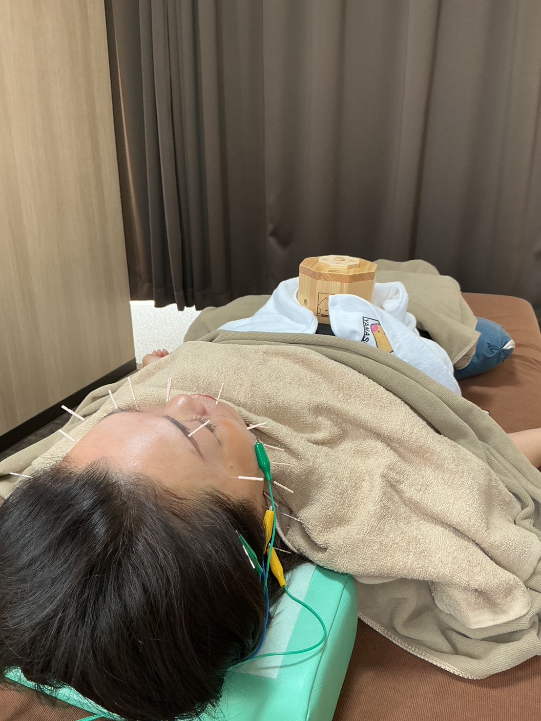 スタンダード美容鍼