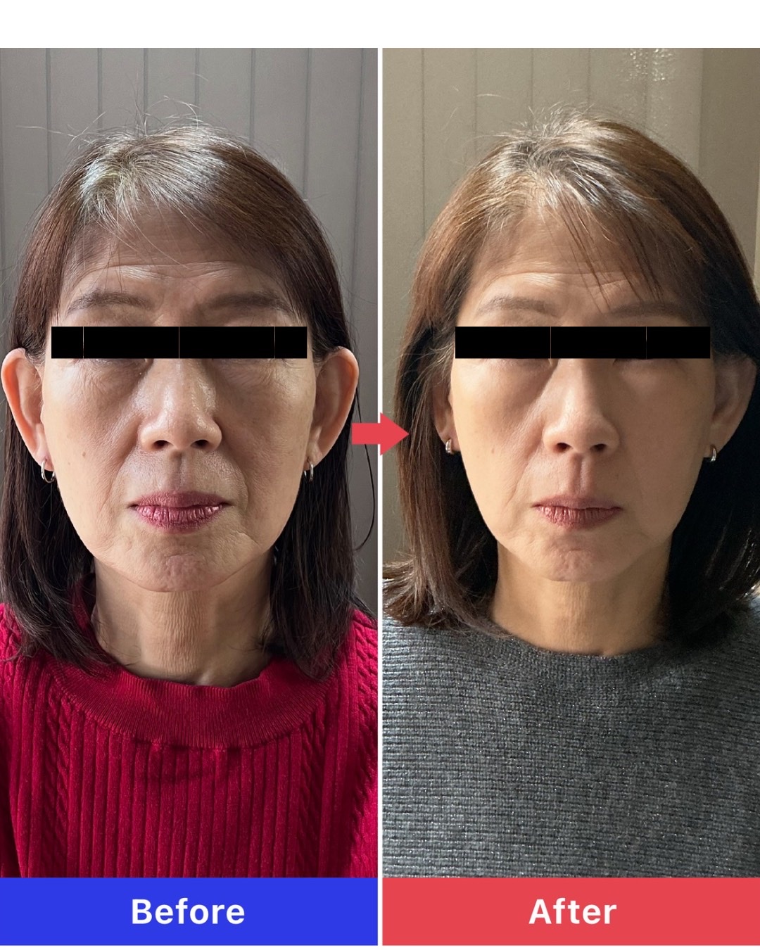 スタンダード美容鍼