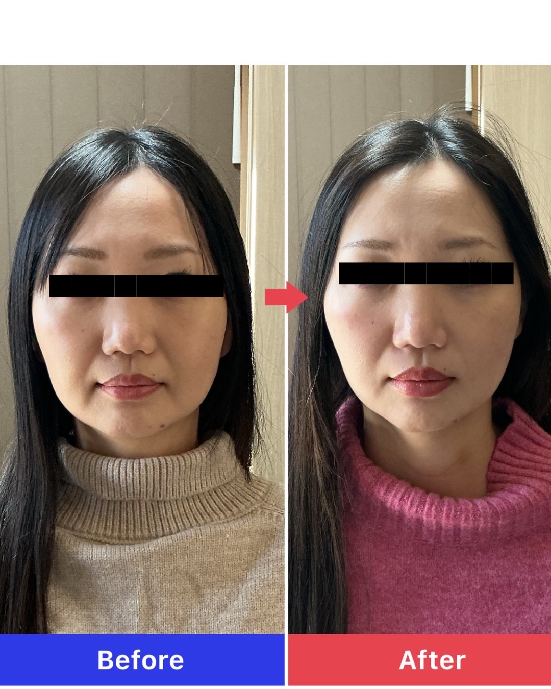 スタンダード美容鍼